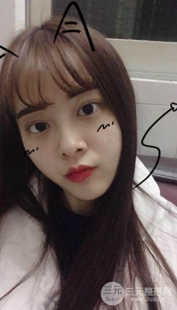 雙眼皮手術(shù)之后的恢復(fù)過(guò)程