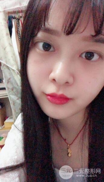 雙眼皮手術(shù)后1-3個(gè)月