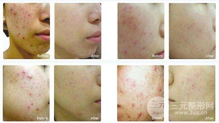 彩光嫩膚祛痘印好嗎