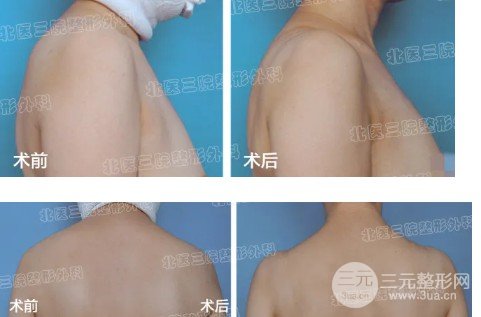 吸脂減肥價格貴不貴