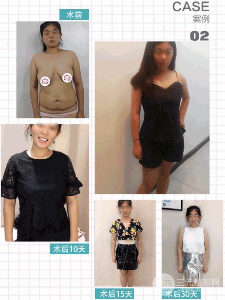 吸脂減肥價格貴不貴