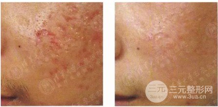 微針美容的大概費(fèi)用