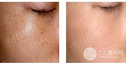 微針美容的大概費(fèi)用