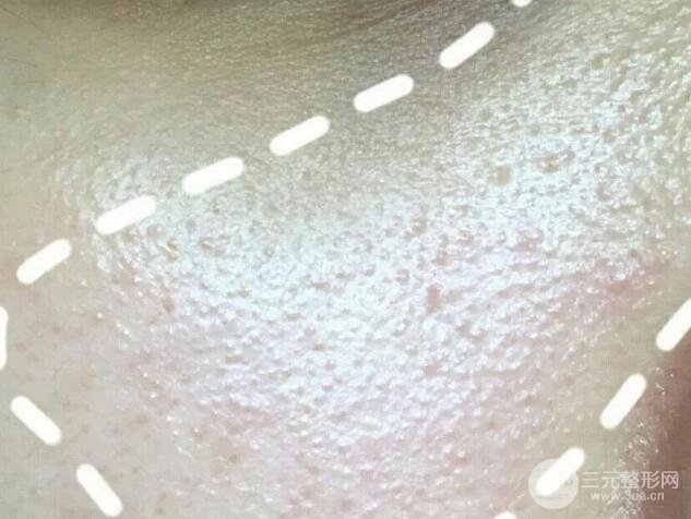 脂肪粒的自白：停用眼霜真的有用嗎？