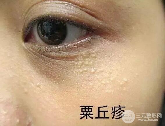 脂肪粒真的是因為護(hù)膚品過剩導(dǎo)致的嗎?