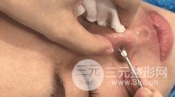 第二步、就是針清啦