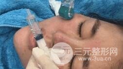 第四步，全臉微針