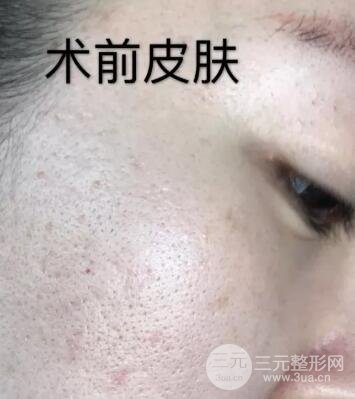 第四步，全臉微針