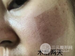 第四步，全臉微針