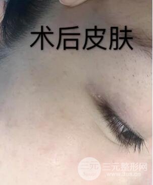 第四步，全臉微針