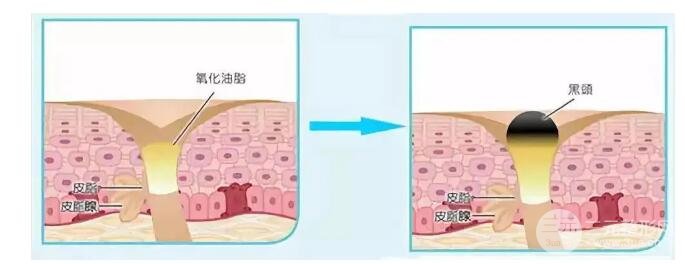 頑固黑頭：黑頭心中刺，拔掉萬般難！