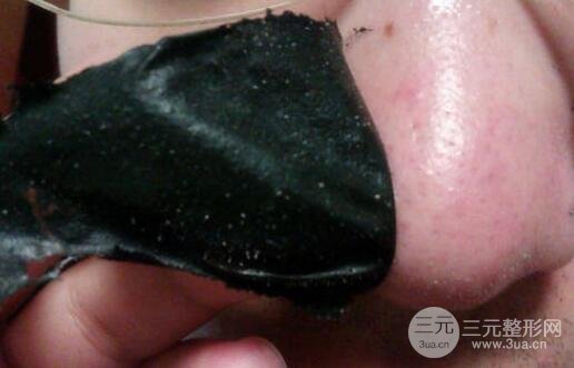 頑固黑頭：黑頭心中刺，拔掉萬般難！