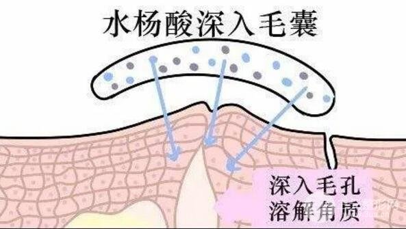 頑固黑頭：黑頭心中刺，拔掉萬般難！