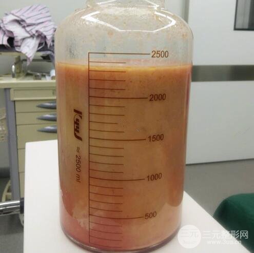 怎樣算抽脂失敗?