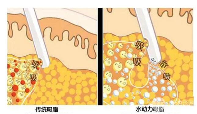 (傳統(tǒng)負(fù)壓抽脂 & 水動力抽脂)