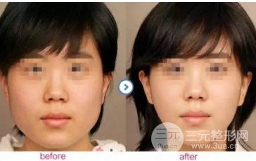 打****注射瘦臉的價格貴嗎