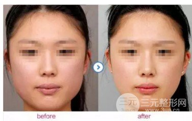 打****注射瘦臉的價格貴嗎