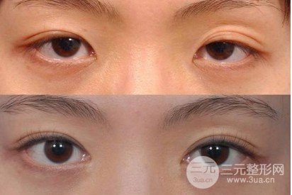 上瞼下垂怎么辦