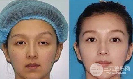 上瞼下垂怎么辦