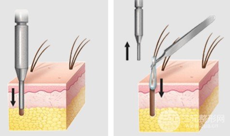 河北省人民醫(yī)院植發(fā)