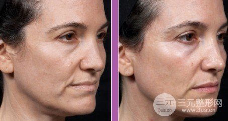 熱瑪吉全臉部價(jià)格表