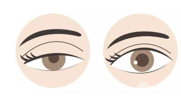 注射瘦臉注射后上瞼下垂，要多久可以復原？