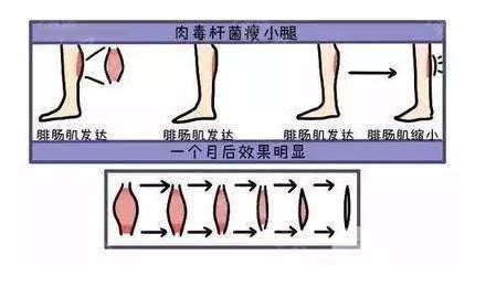 減肥瘦腿方法醫(yī)院怎么做