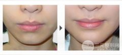 墊下巴前后對(duì)比圖，下巴后縮一定要矯正牙齒嗎？
