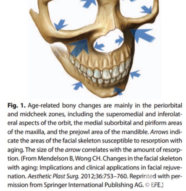 A型注射瘦臉與填充劑在面部美容中的聯(lián)合應(yīng)用總結(jié)