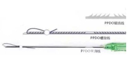 埋線除皺和熱瑪吉哪個后期果好