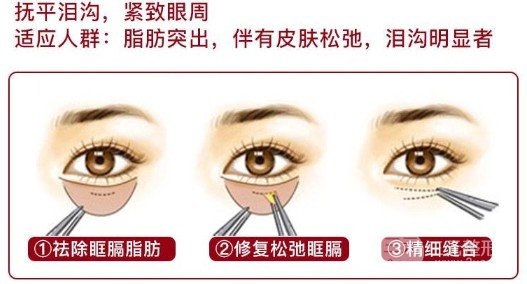 找去眼袋較有的方法