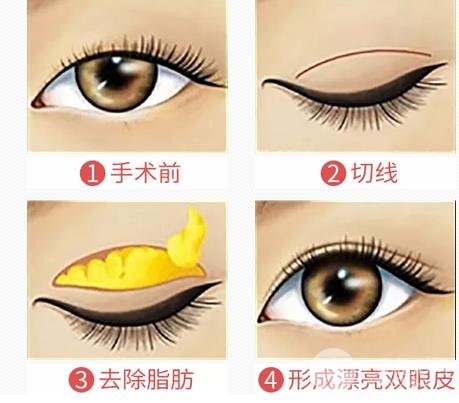割雙眼皮幾種常見問題