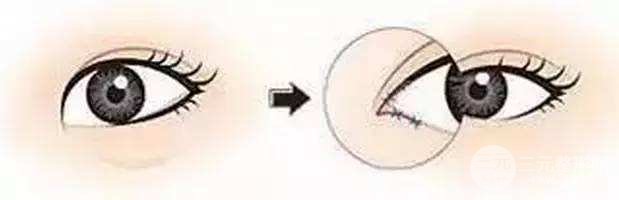 開眼角手術(shù)多久能恢復(fù)