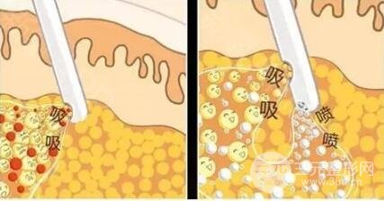 吸脂減肥價(jià)格是多少?