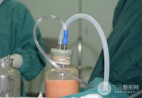 共振吸脂術(shù)