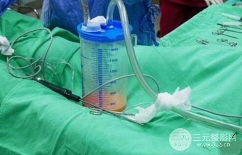 吸脂術(shù)的危害