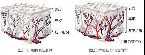 毛細(xì)血管擴(kuò)張