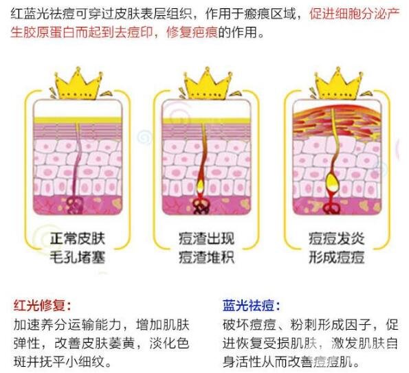 紅藍(lán)光祛痘