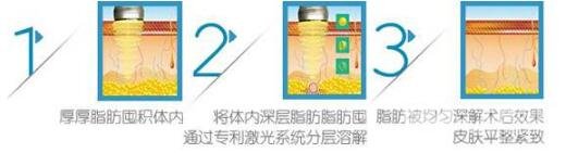 面部光纖溶脂后多久能夠看到果?