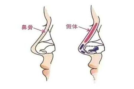 在做假體隆鼻時(shí)，我們應(yīng)該注意什么?