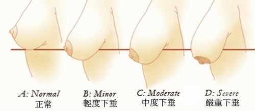 引起乳房下垂的因素有四點(diǎn)：