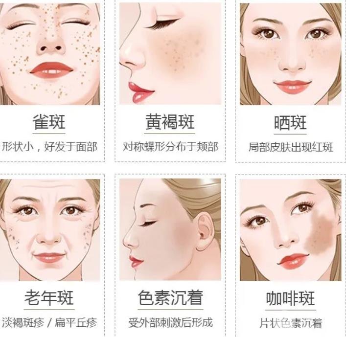 激光祛斑會(huì)反彈嗎