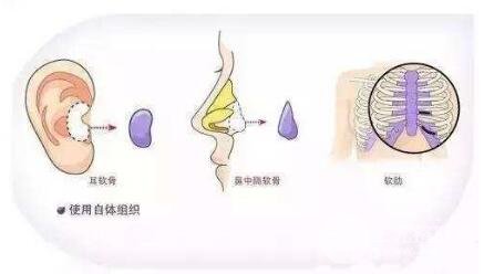 耳朵軟骨隆鼻是什么樣的?