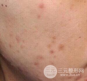 彩光祛痘果怎么樣?