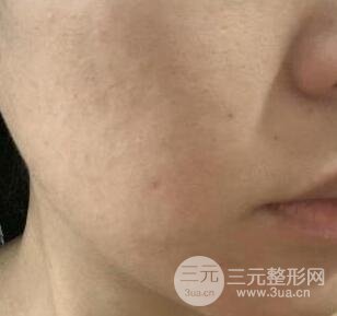 彩光祛痘果怎么樣?