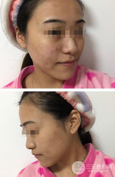 彩光祛痘案例分享