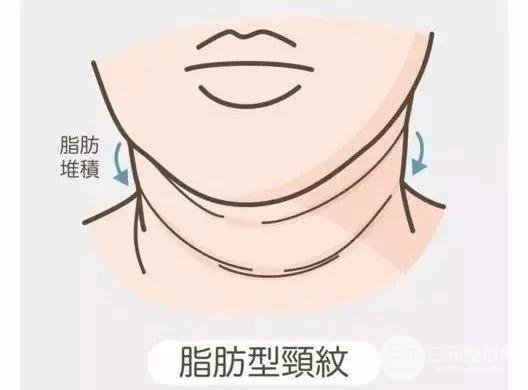 頸紋類型
