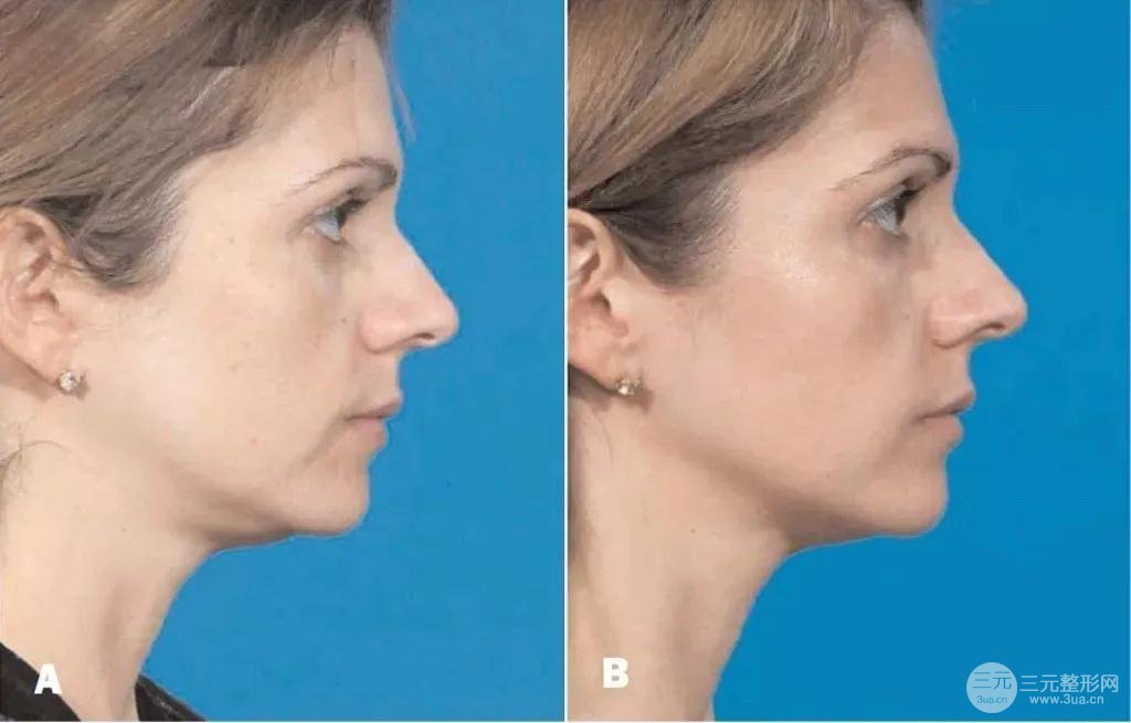 熱瑪吉消除頸紋