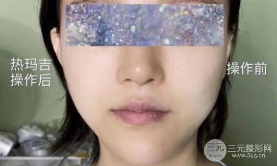 熱瑪吉緊膚果對(duì)比圖