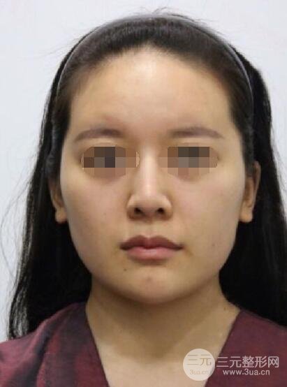 下頜角整形案例術(shù)前